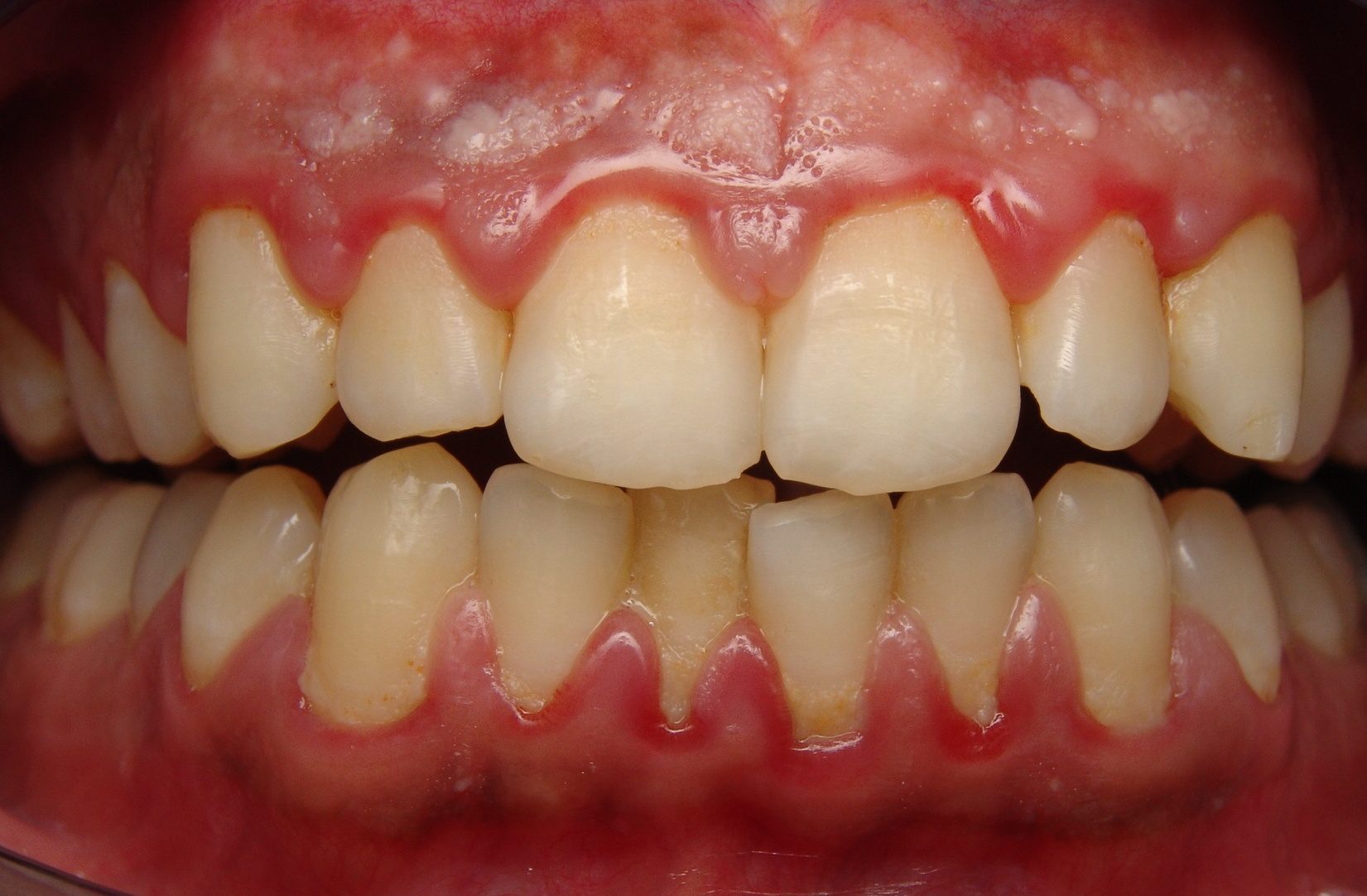 pathological fear of gums