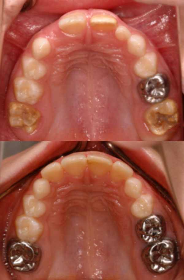 healing translucent tooth enamel