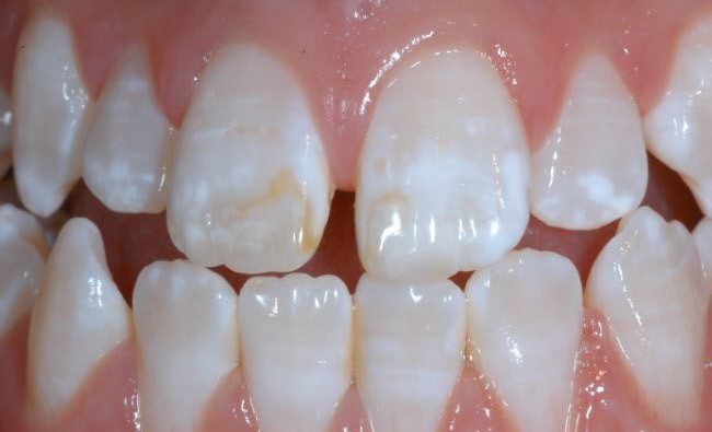 no enamel on milk teeth