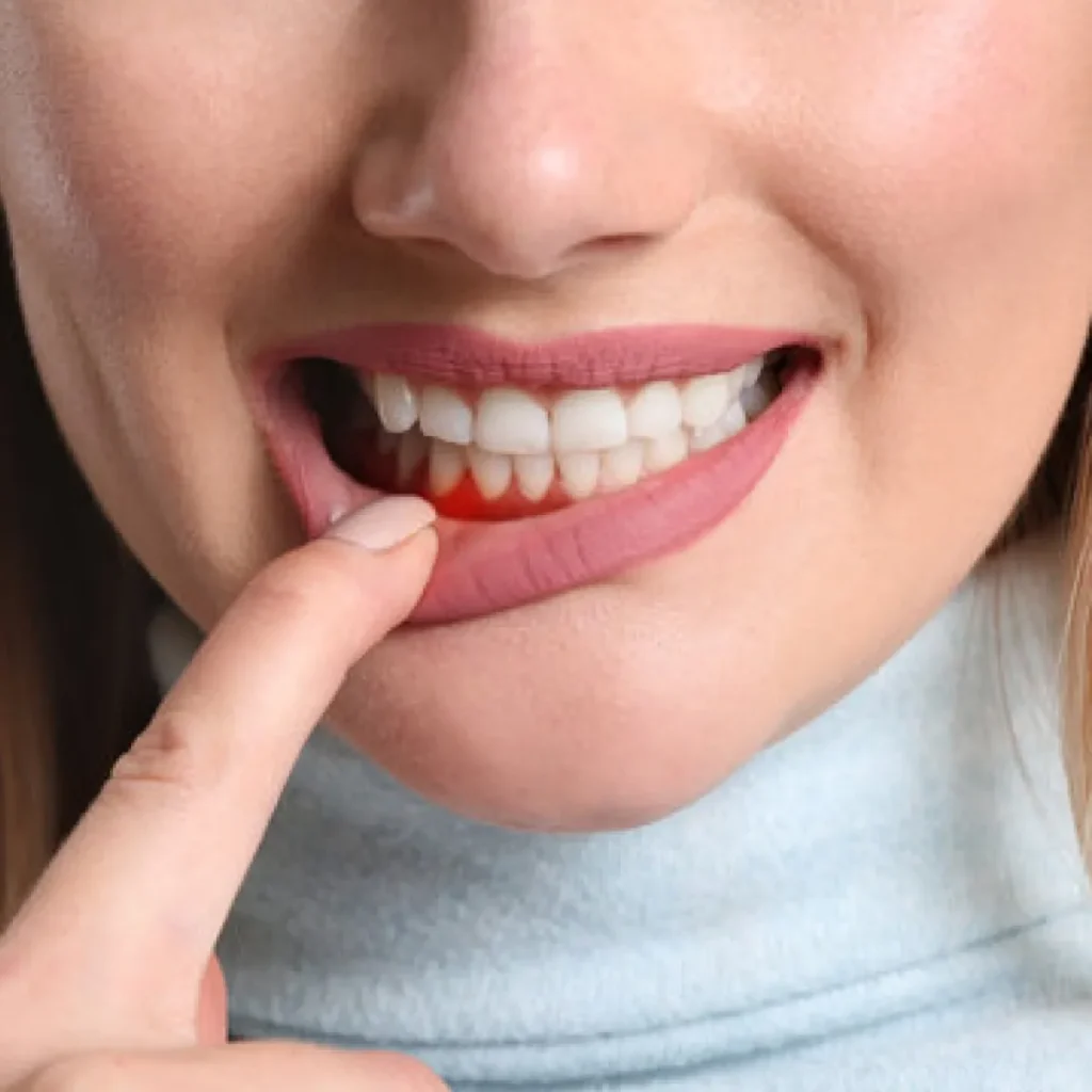 Close-up of a woman pulling her lower lip to reveal inflamed red gums, suggesting a dental issue. Her expression looks concerned.