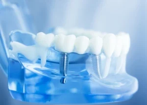 after dental implant placement illustration