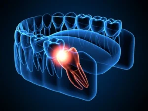 impacted wisdom tooth illustration impacted wisdom tooth illustration