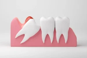 impacted wisdom tooth trying to erupt impacted wisdom tooth trying to erupt