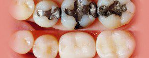 Tooth Coloured Fillings