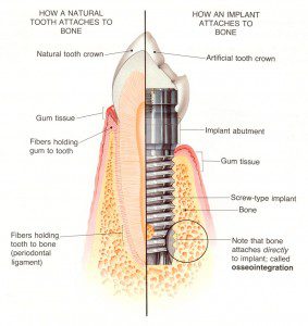 dental_implant