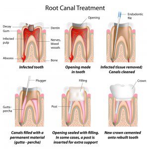 root-canal