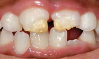 Tooth Enamel Defects
